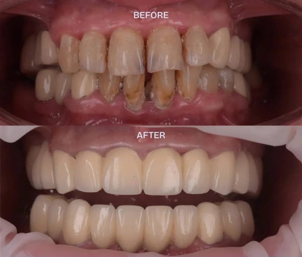 Before and after — complete oral rehabilitation with 12 dental implants
