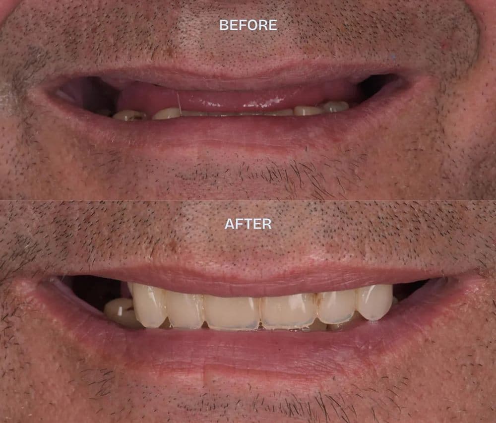 Vorher und nachher — Implantatgetragene Zähne
