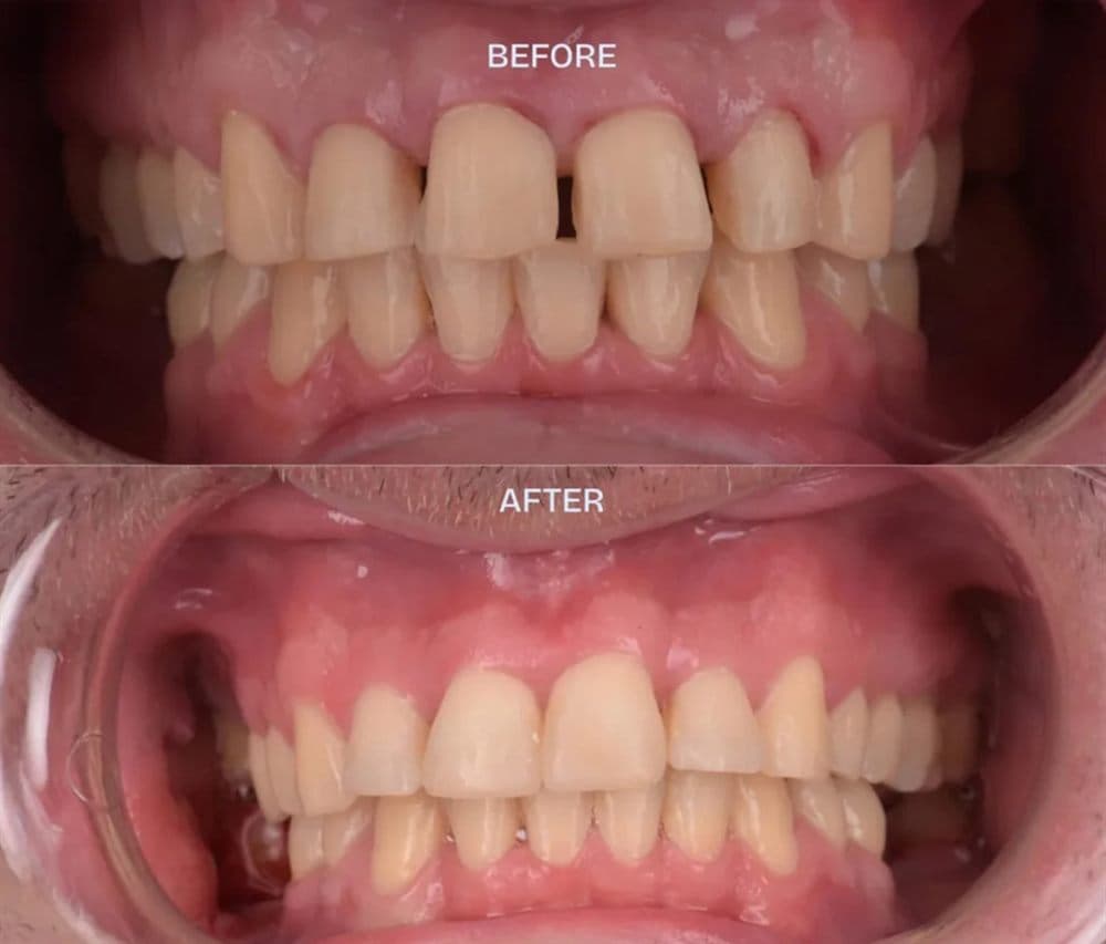 Before and after — Smile makeover