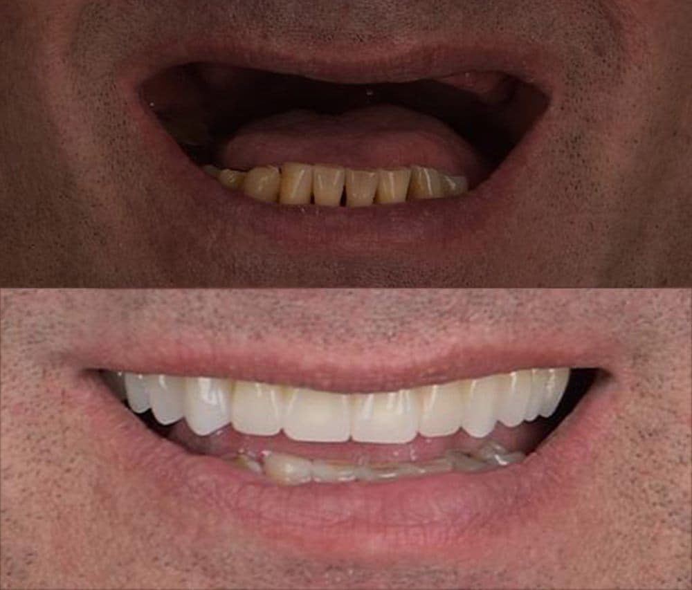 Before and after — Crowns & bridgework