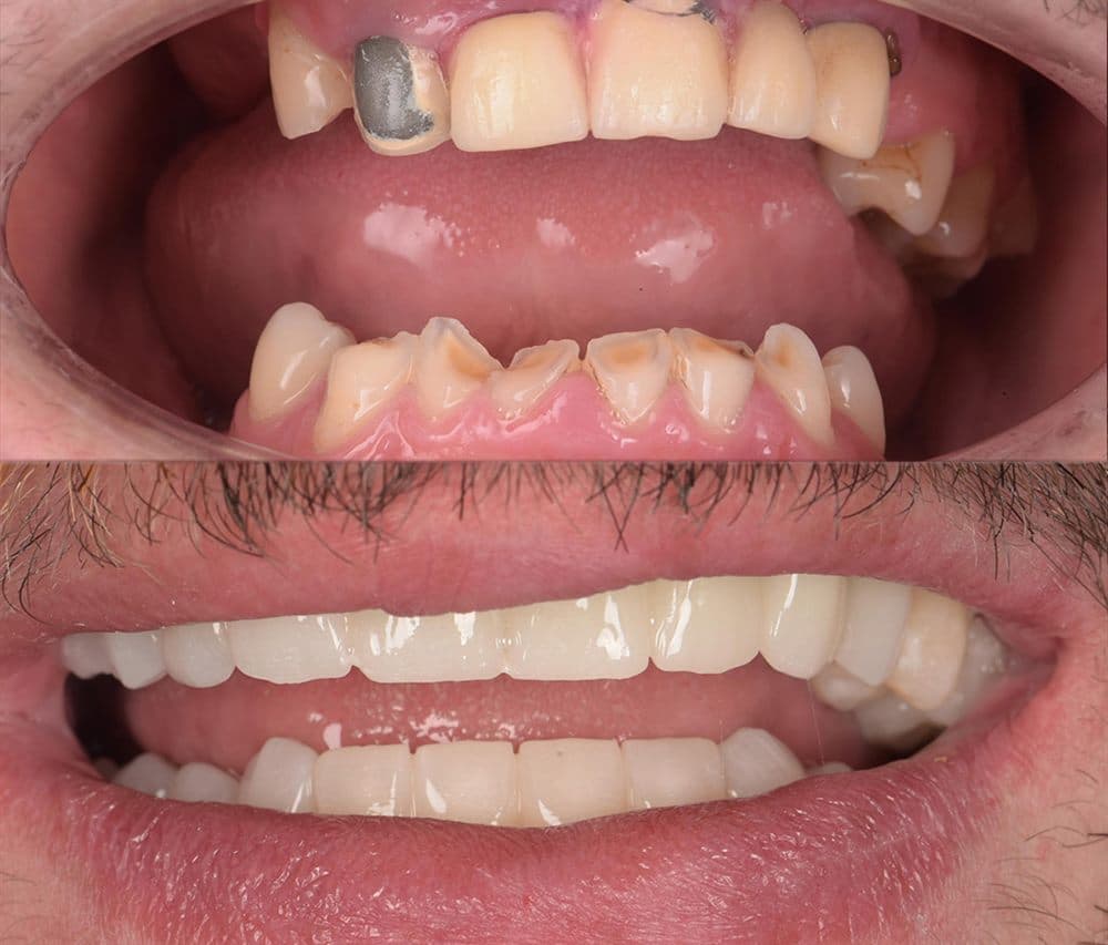 Before and after — Upper & lower restoration
