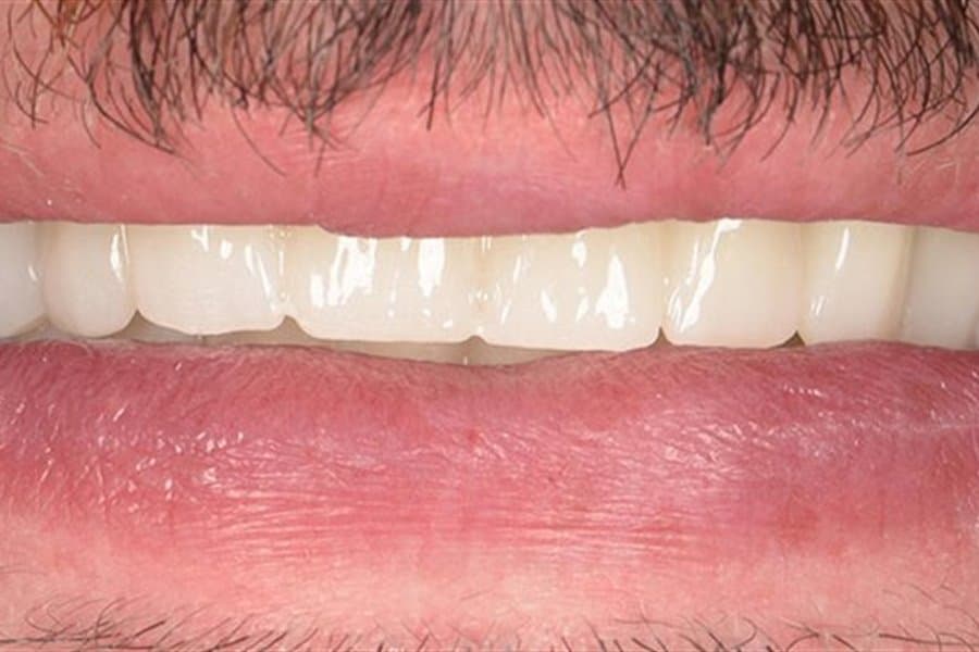 Veneers in Rumänien: Kosten, Arten und was Patienten aus dem DACH-Raum wissen sollten